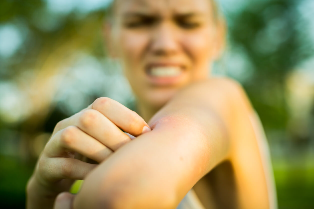 Spider Bite On Finger Swelling